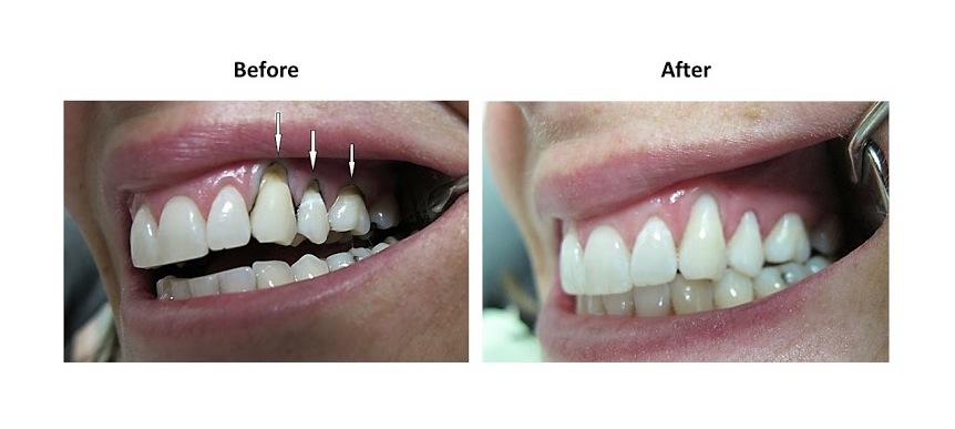tooth decay