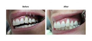tooth decay